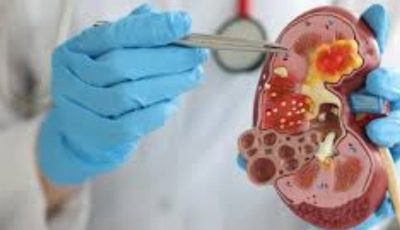 تسبب آلاما شديدة.. أهم أسباب وأعراض حصوات الكلى