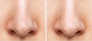 4 طرق ناجحة للتخلص من الرؤوس السوداء على الأنف