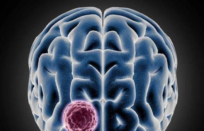 لا تتجاهلها.. أعراض تشير للإصابة بسرطان الدماغ