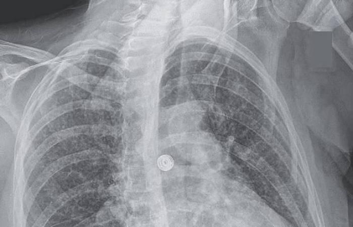 اكتئاب يكشف إصابة أمريكية بـ«السل المنتشر»