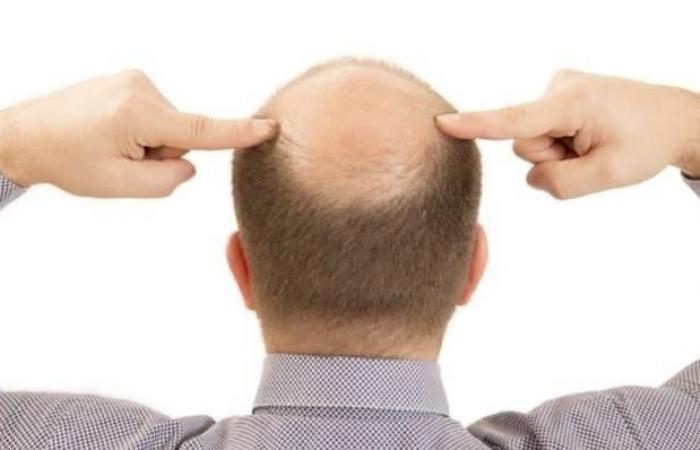 يحفز نمو الشعر في 20 يوما فقط.. علماء يطورون علاجاً نهائياً للصلع